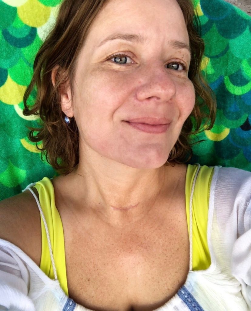 Thyroid Removed Things I didn't Know Miami Moms Blog