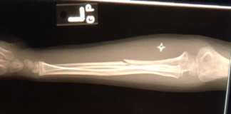 Casts & Kids: 10 Things to do with a Cast in Miami Image: An x-ray of a broken arm