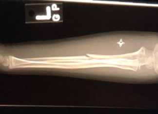 Image: An x-ray of a broken arm