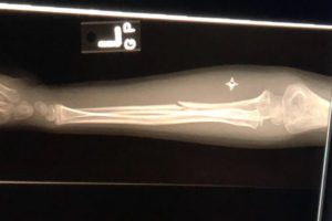 Image: An x-ray of a broken arm