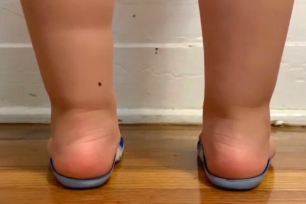A toddler demonstrating the use of custom shoe inserts